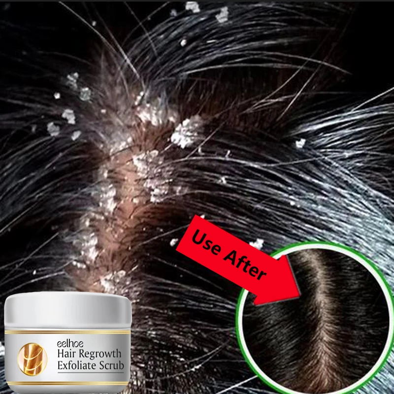 Fast Anti Dandruff Hair Treatm - Hair Care Dandruff 评论和价格